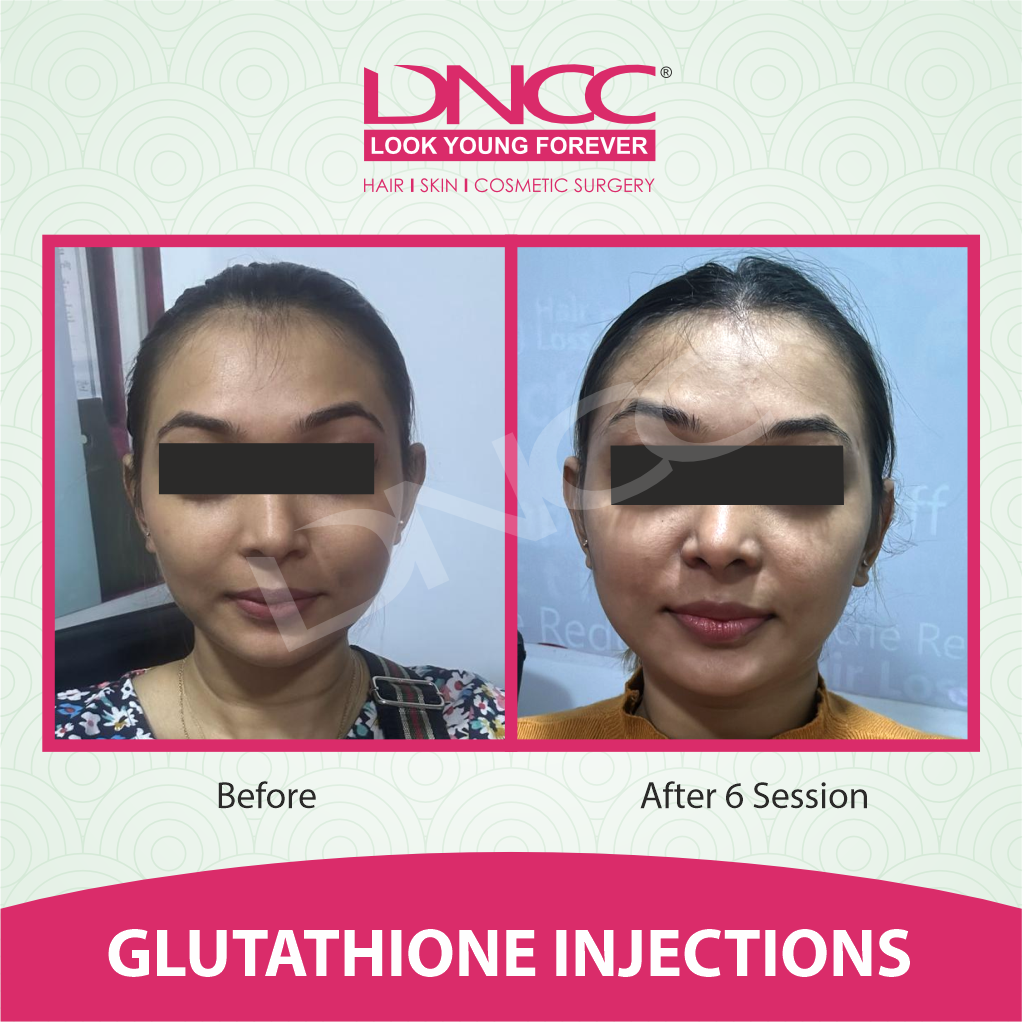 Hair Transplant Transformation 1